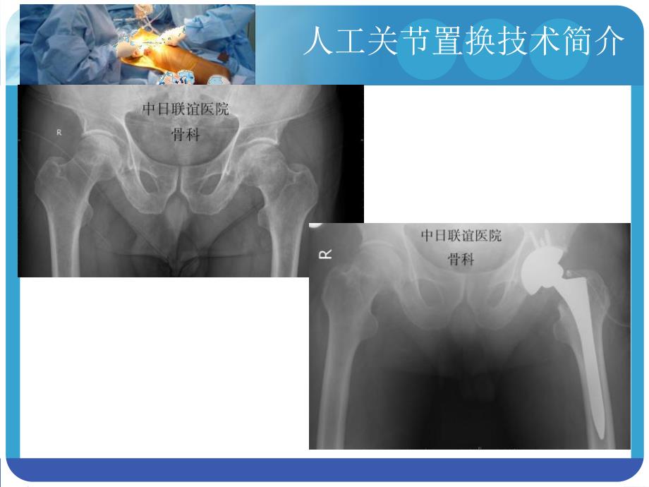 康复治疗在人工关节置换术治疗中的进展及发展方向.ppt.ppt_第3页