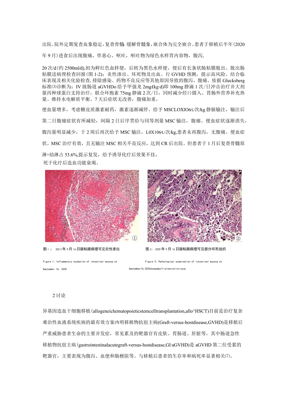 间充质干细胞治疗单倍体造血干细胞移植术后肠道重度aGVHD1例并文献复习.docx_第3页