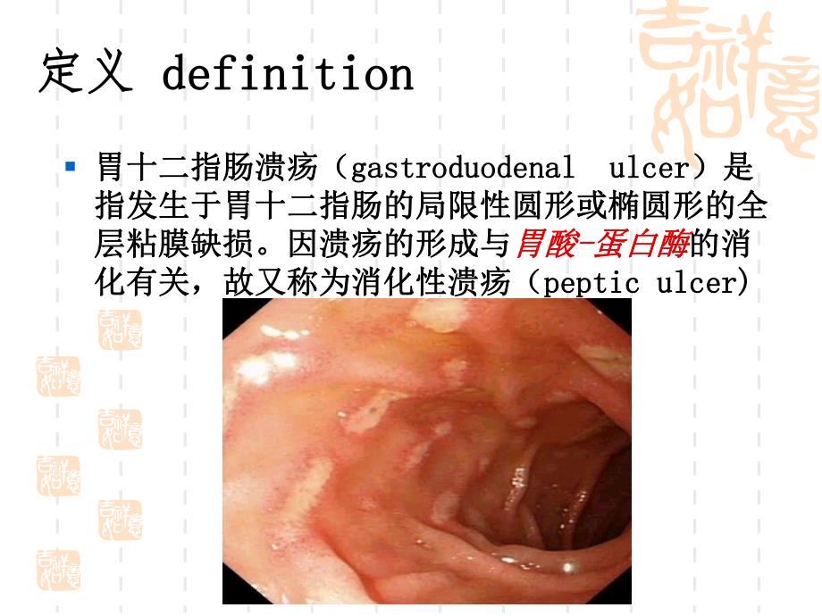 胃十二指肠溃疡.ppt_第2页