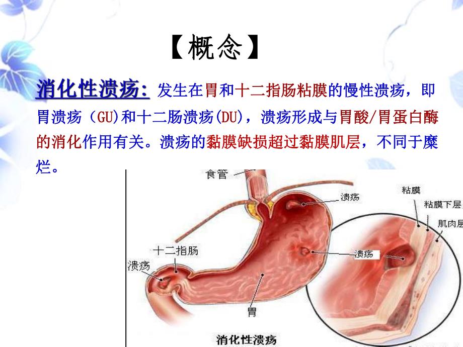 消化性溃疡的护理.ppt_第2页