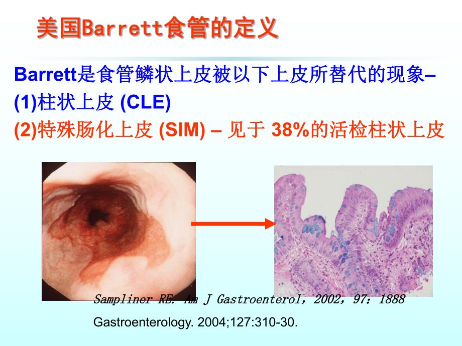 Barrett食管诊断与治疗.ppt_第2页