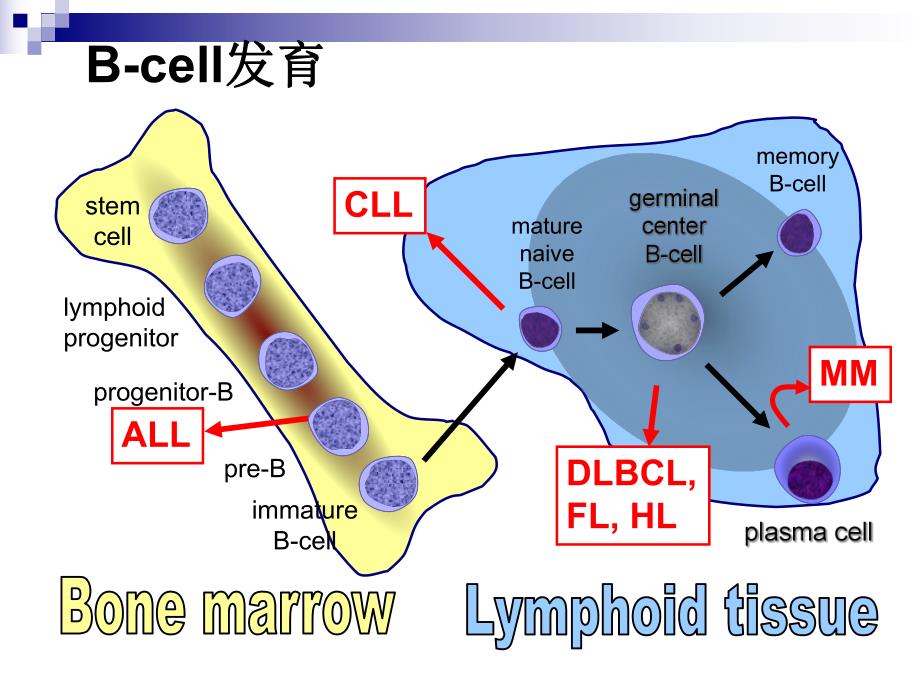 B淋巴细胞增殖性疾病鉴别诊断.ppt_第2页
