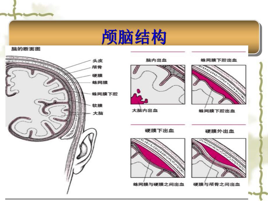 蛛网膜下腔出血的观察及护理.ppt_第2页