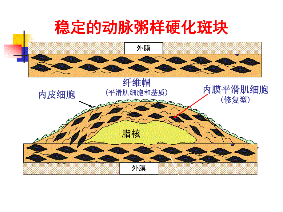 动脉硬化心脏病.ppt_第1页