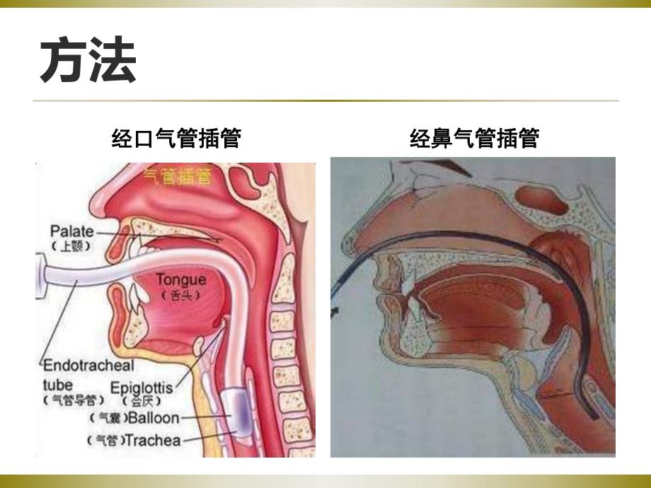 气管插管的护理.ppt_第3页