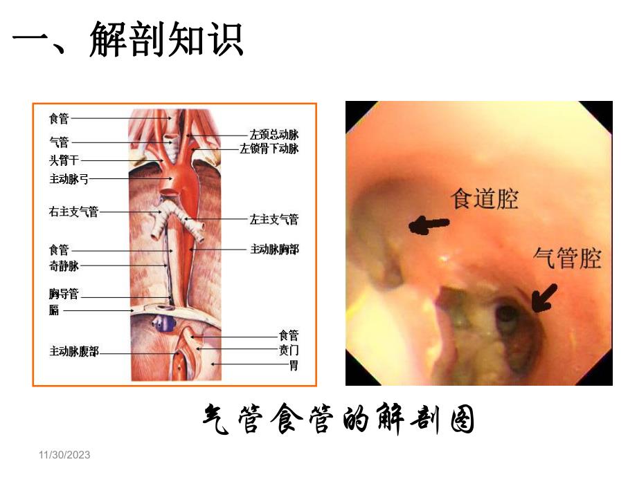 气管食管瘘.ppt_第3页