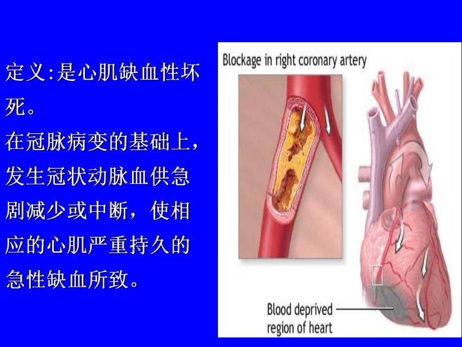 心肌梗死相关知识.ppt.ppt_第2页