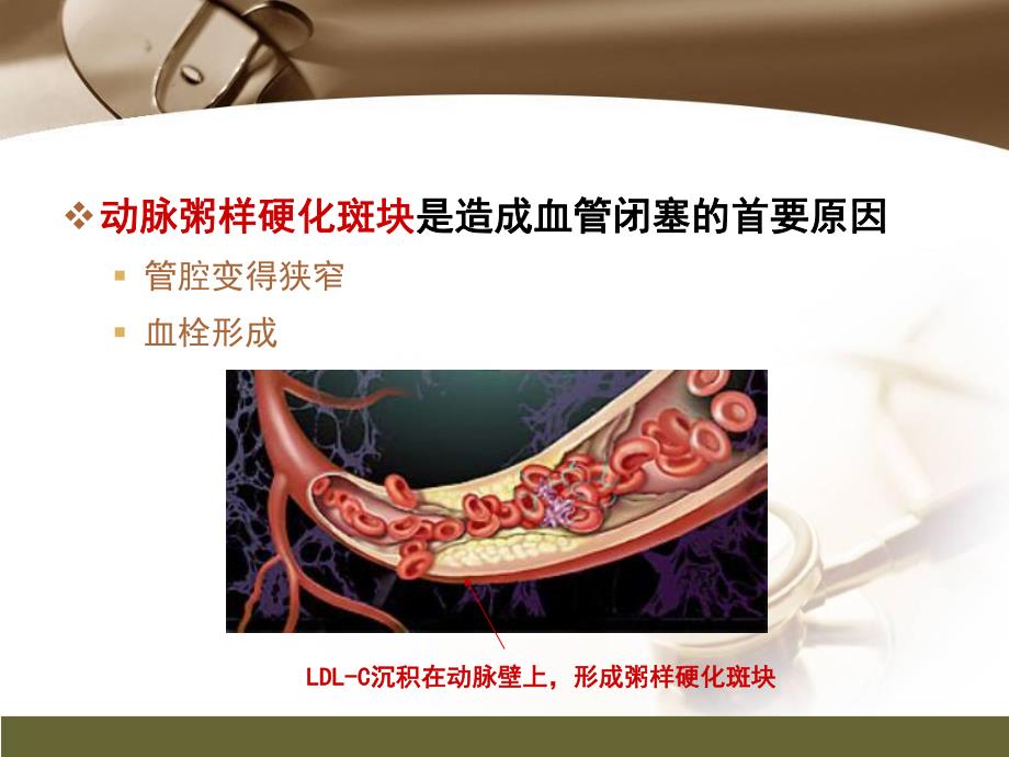 心肌梗死健康宣教.ppt_第3页