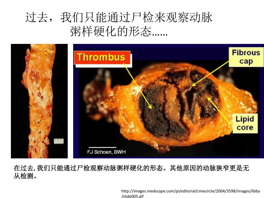 症状性颅内动脉狭窄患者的最佳药物治疗.ppt_第2页