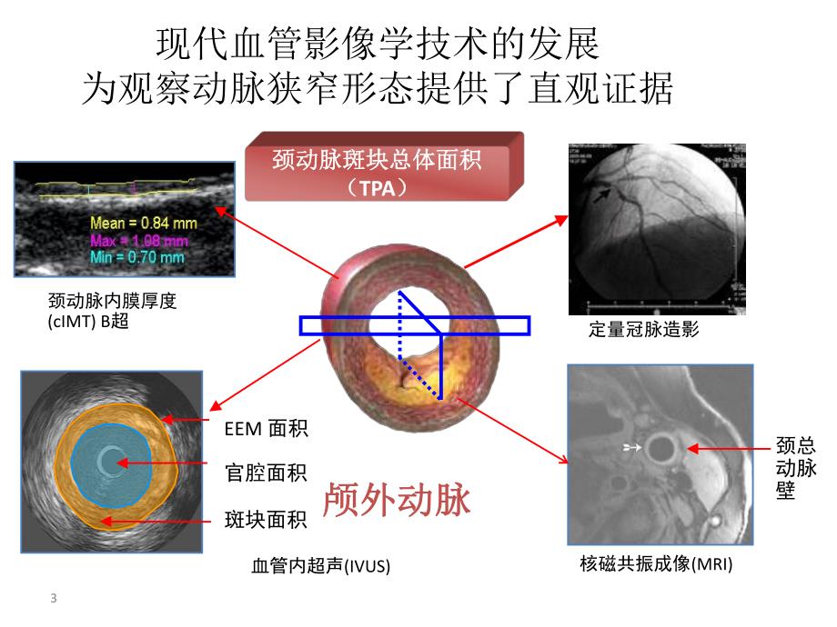 症状性颅内动脉狭窄患者的最佳药物治疗.ppt_第3页