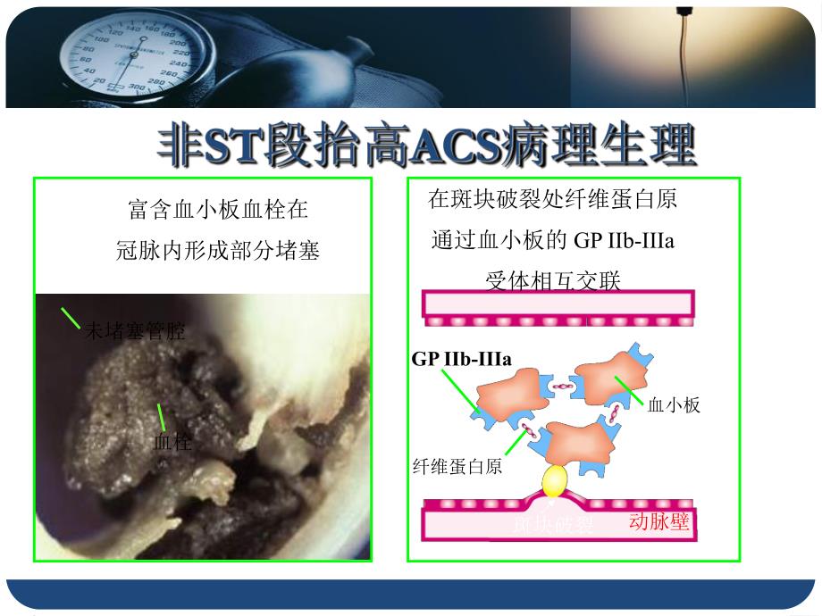 替罗非班在ST段抬高型心肌梗死急诊介入治疗中的应用研究.ppt_第3页