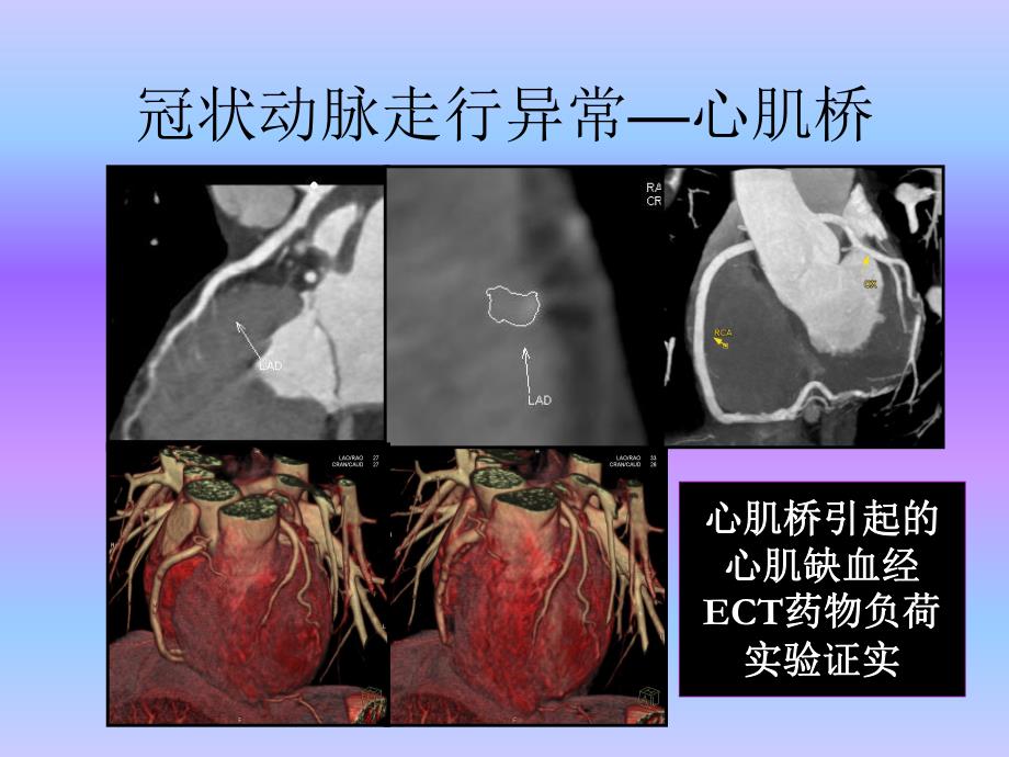 心血管疾病64层CTA诊断（三） .ppt_第1页