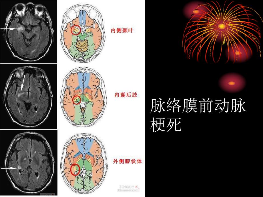 梗死部位和责任血管.ppt_第2页