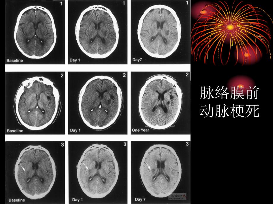 梗死部位和责任血管.ppt_第3页