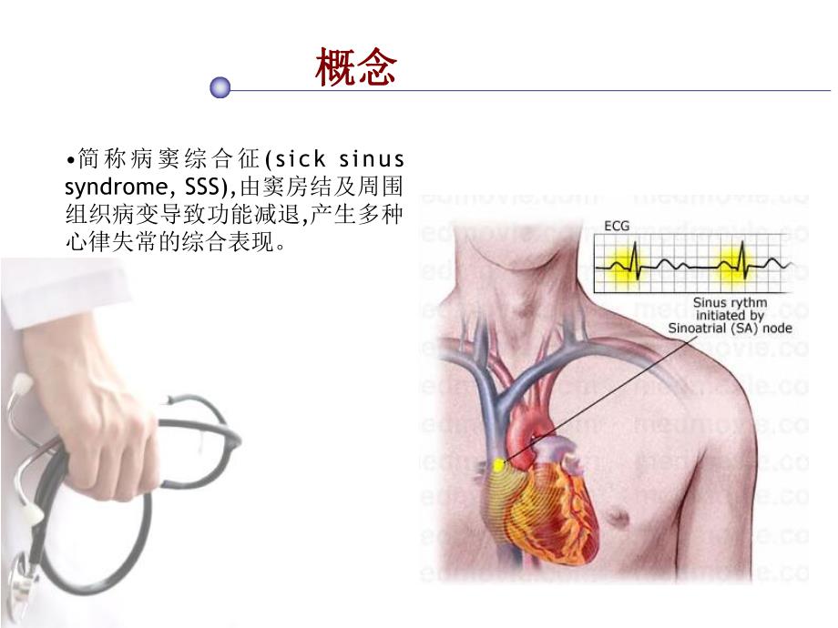 病态窦房结综合征.ppt_第2页