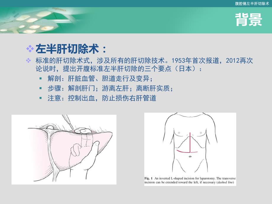 腹腔镜左半肝切除术日趋标准化.ppt_第3页