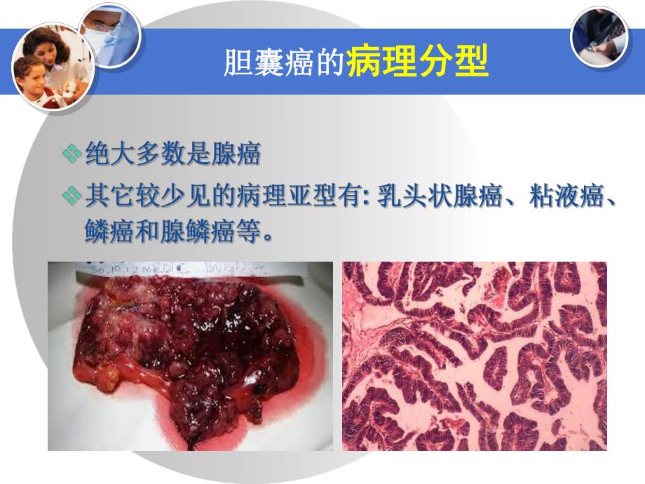 胆囊癌的诊断与治疗.ppt_第3页