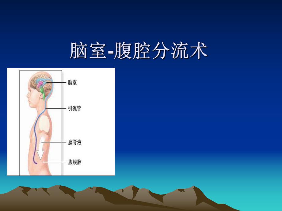 脑室腹腔分流术.ppt_第1页