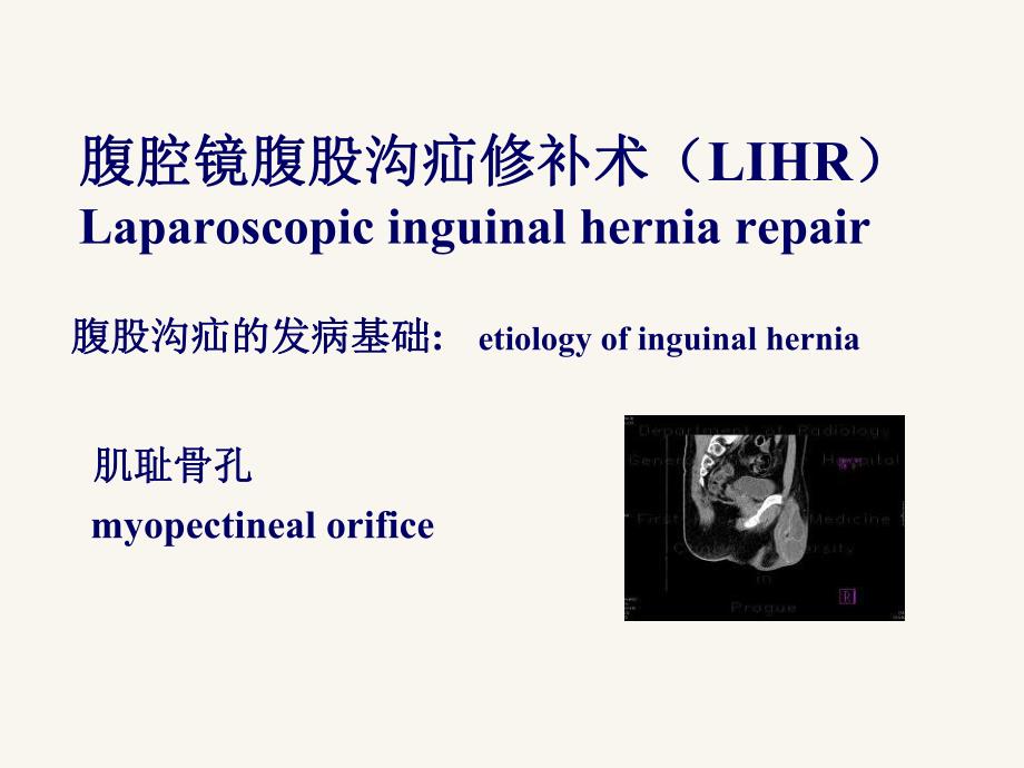 腹腔镜腹股沟疝修补术.ppt.ppt_第2页