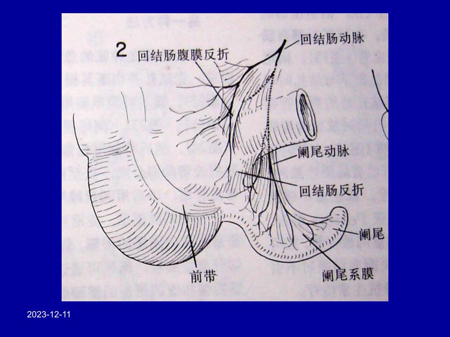 急性阑尾炎手术治疗.ppt_第2页