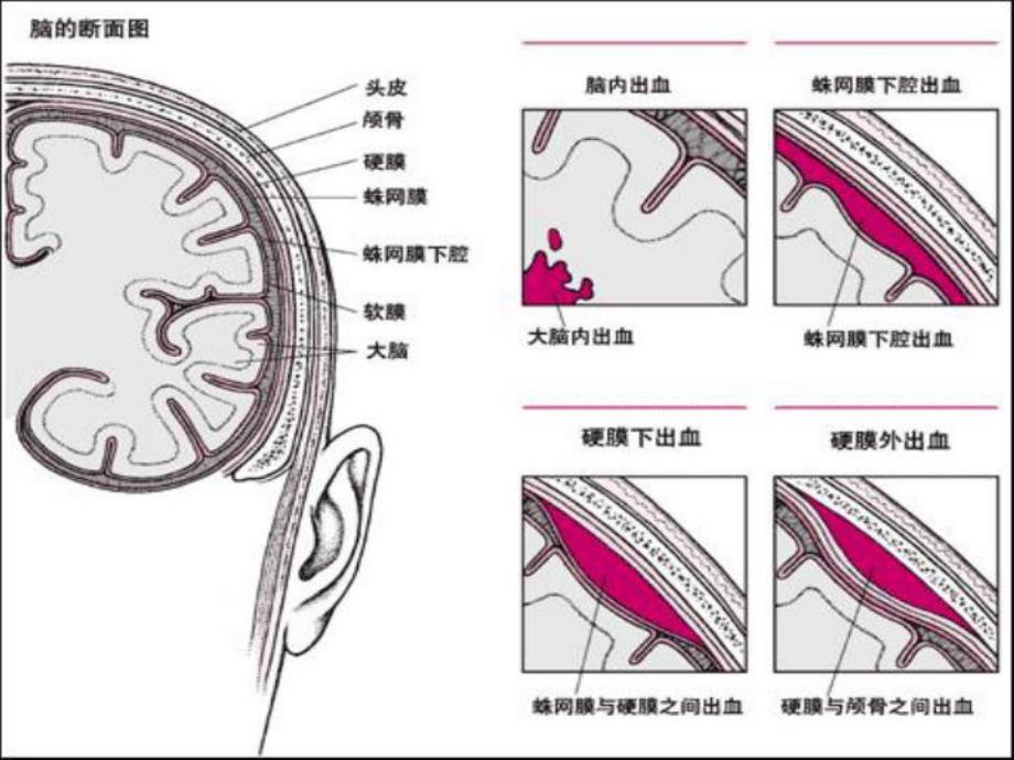 神经外科常见引流管的护理2.ppt_第2页