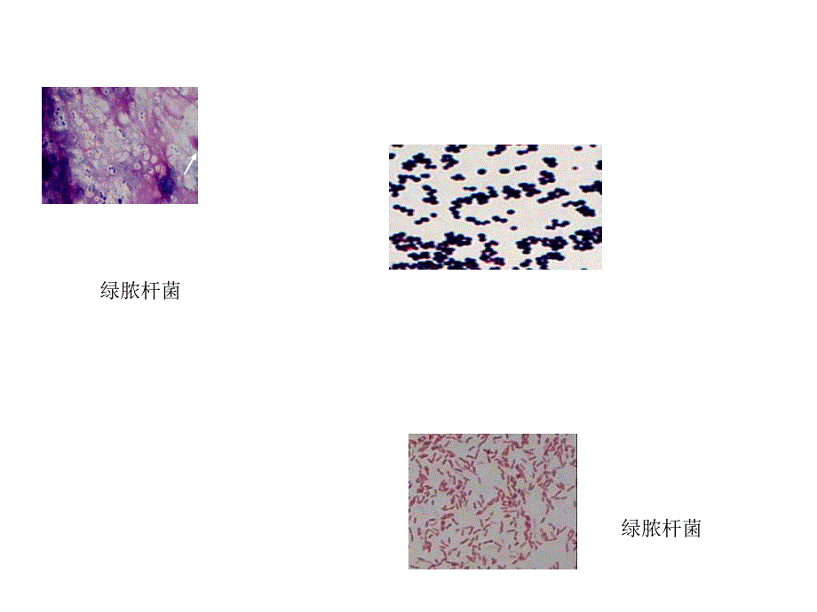 三、细菌性角膜炎(图片).ppt_第2页