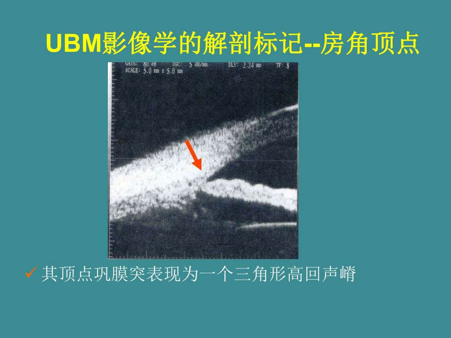 UBM在青光眼临床中的应用.ppt_第3页