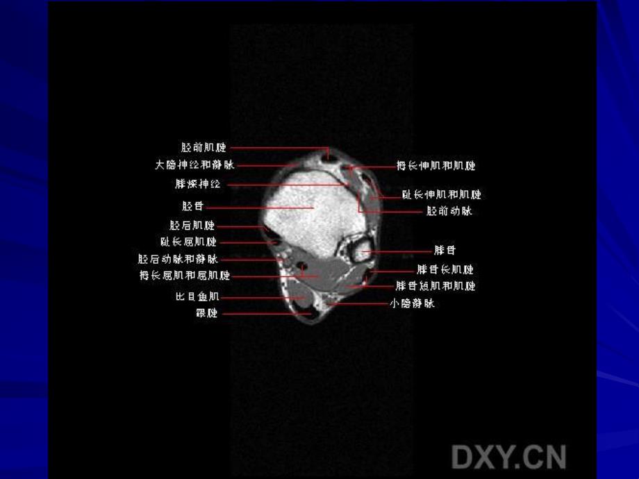 正常踝关节MR解剖.ppt_第2页