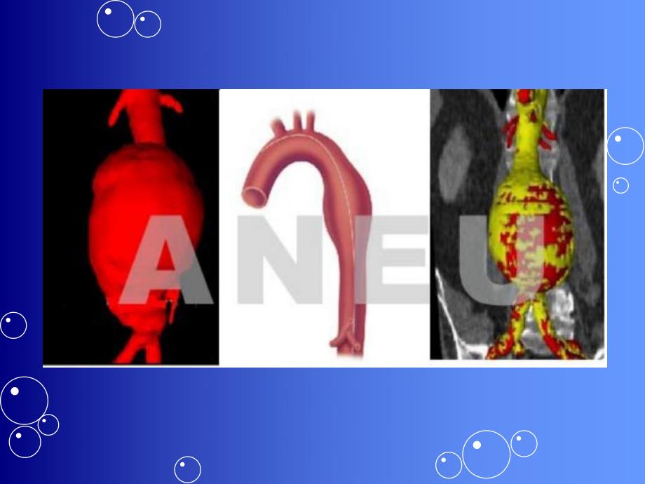 主动脉瘤及主动脉夹层的分型.ppt_第3页