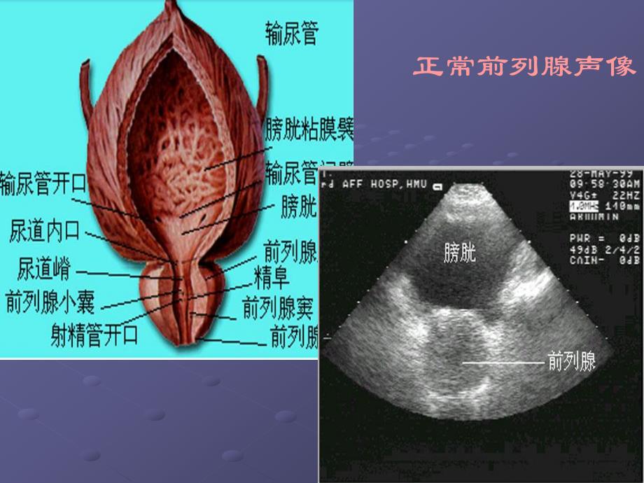 前列腺等超声诊断.ppt_第3页