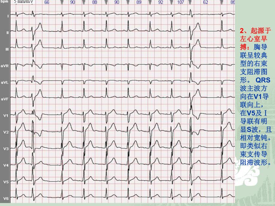 室性早搏定位诊断2.ppt_第3页