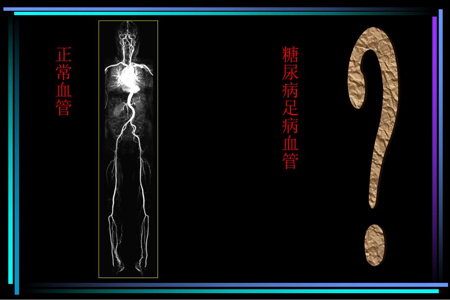 CEMRA对糖尿病足血管病变的诊断价值.ppt_第2页