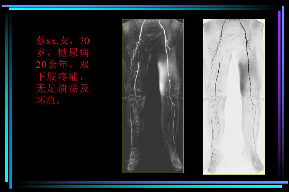 CEMRA对糖尿病足血管病变的诊断价值.ppt_第3页