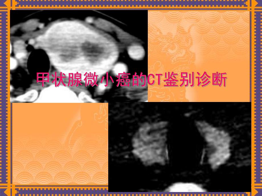 甲状腺病变的CT诊断.ppt_第1页