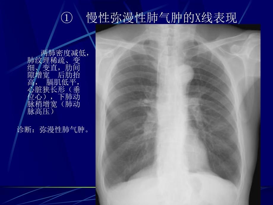 呼吸系统基本病变影像表现.ppt_第3页