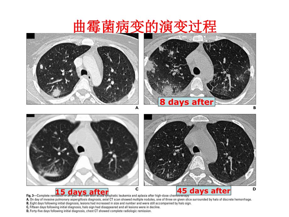 医院肺真菌病的影像诊断4.ppt_第2页