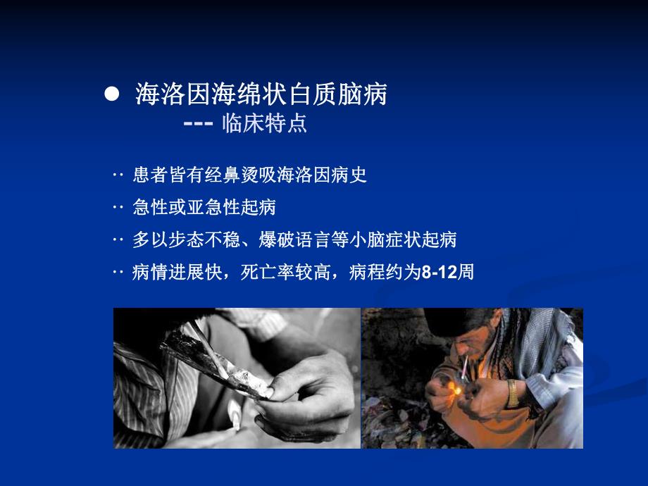 海洛因中毒性脑白质病影像学表现.ppt_第3页