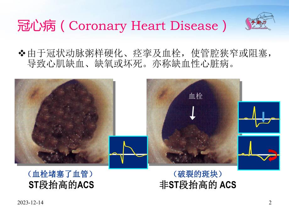 冠心病的超声诊断思维要点.ppt_第2页