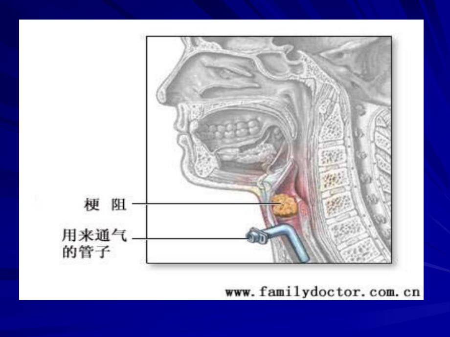 急性喉梗阻.ppt_第3页