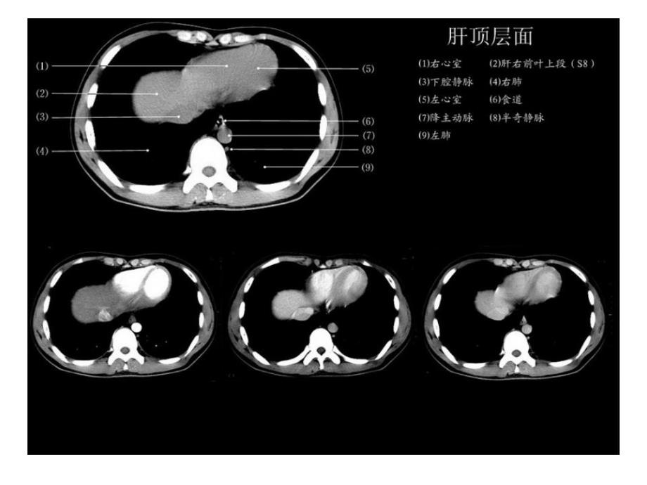 正常肝脏CT解剖.ppt_第2页