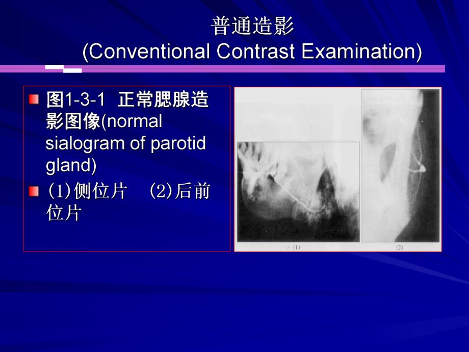 涎腺疾病与颞下颌关节疾病影像诊断.ppt_第3页