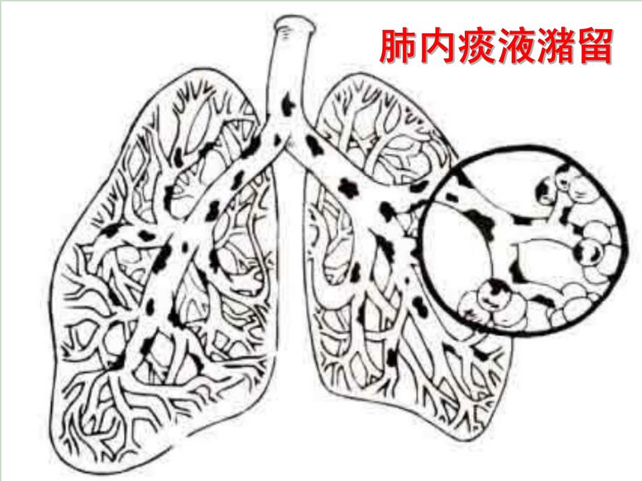 教学PPT胸部物理治疗.ppt_第3页