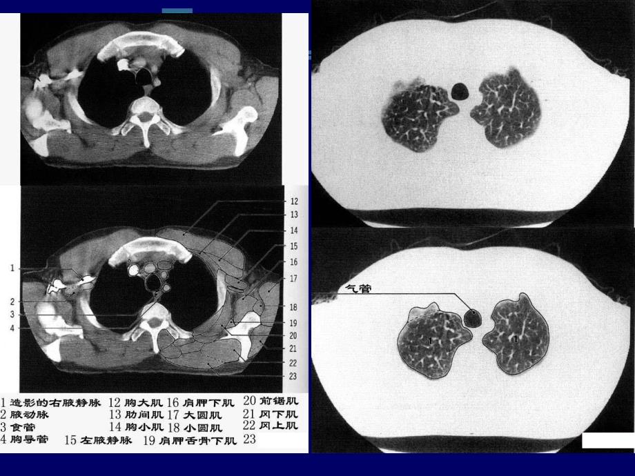 CT胸部正常解剖.ppt_第3页
