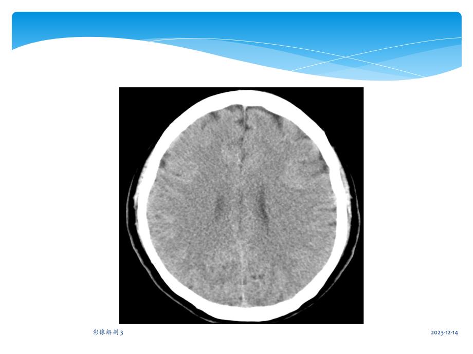 中枢神经系统CT诊断.ppt_第3页