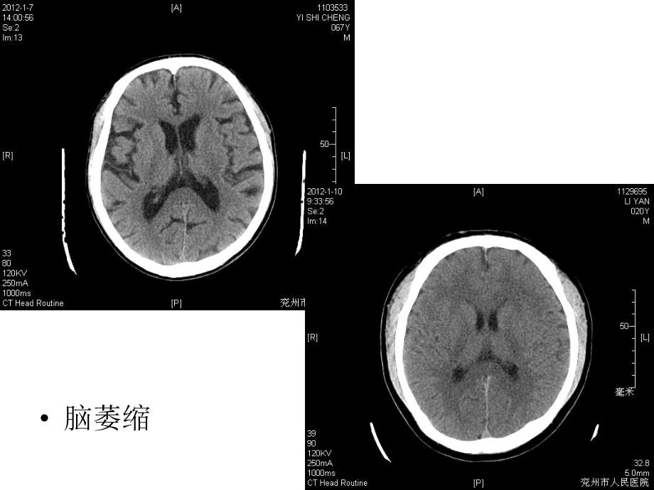 医院颅颈部MRI图片(上).ppt_第2页