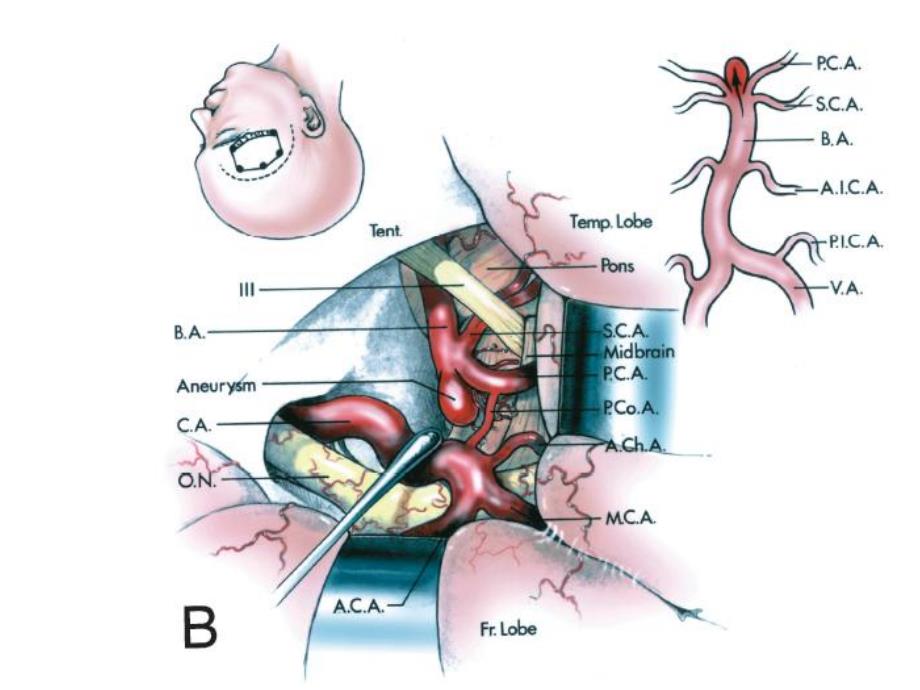 后循环动脉瘤手术入路.ppt_第2页