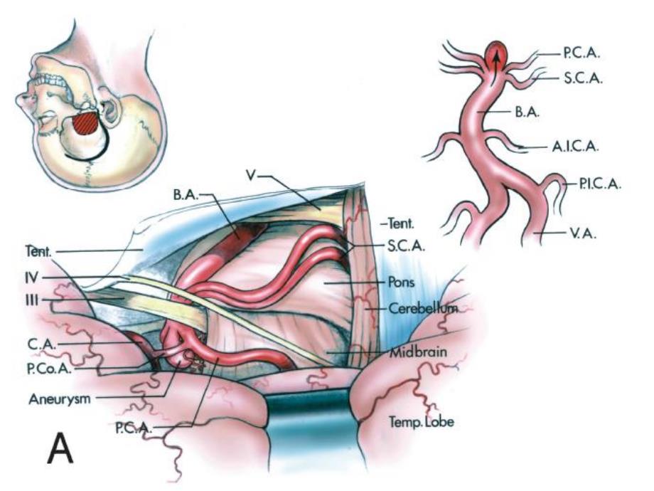 后循环动脉瘤手术入路.ppt_第3页