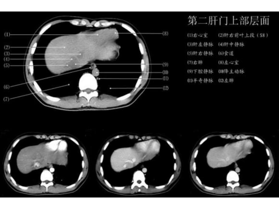 上腹部CT各个层面.ppt_第3页