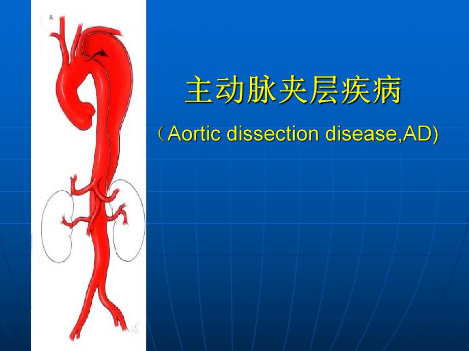 主动脉夹层.ppt.ppt_第1页