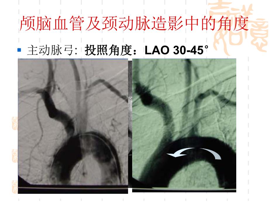 脑血管造影角度选择.ppt_第2页